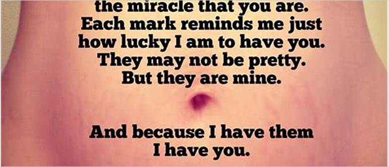 Stretch marks quotes